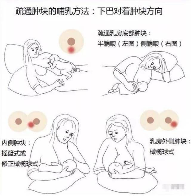 產(chǎn)后漲奶，疼痛難忍怎么辦？