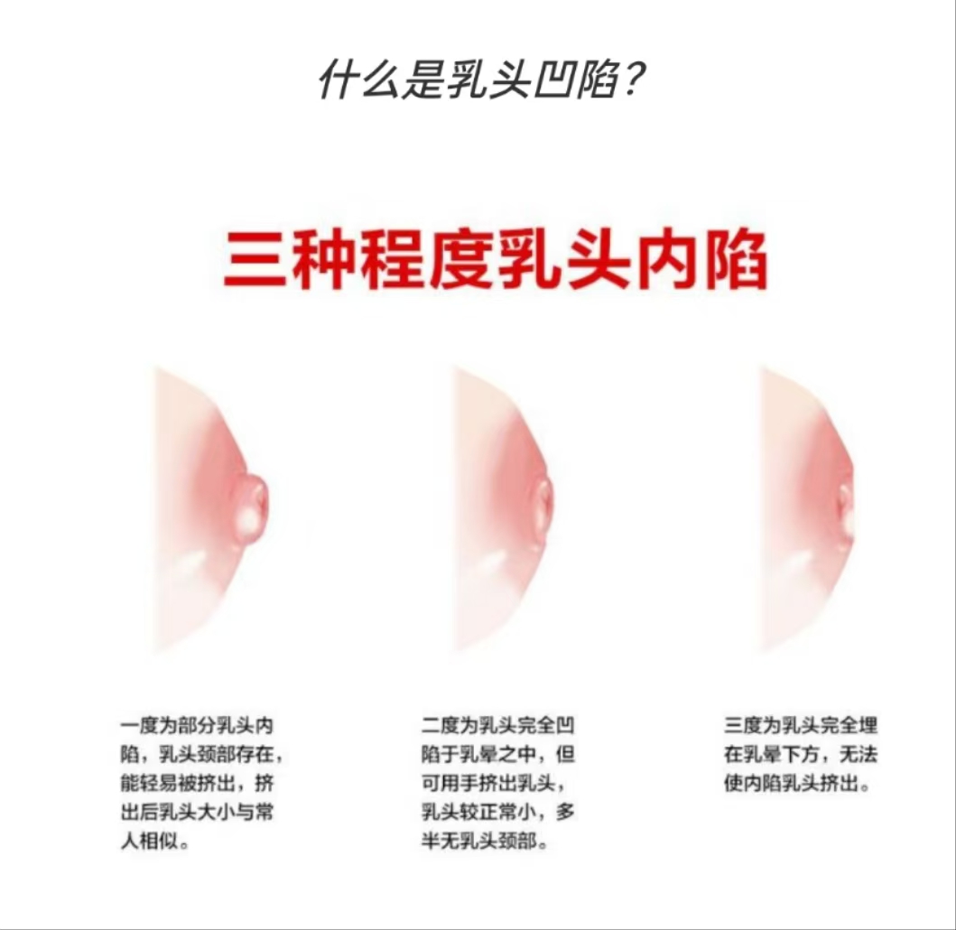 乳頭凹陷的媽媽該如何哺乳？