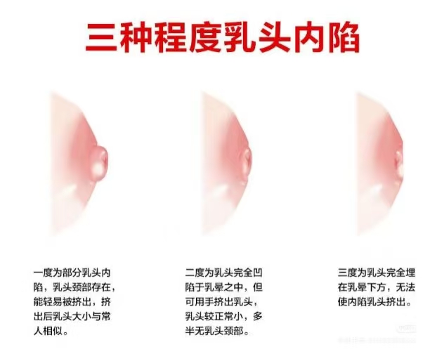 乳頭凹陷的媽媽該如何哺乳？